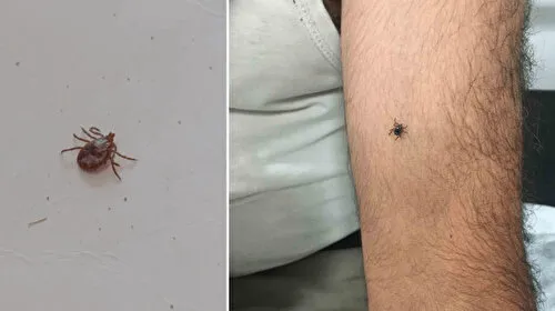 Kayseri'de Kene Alarmı! Yeni Vaka Panik Yarattı
